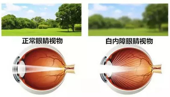 中卫爱尔：白内障人工晶体如何选择(图1)