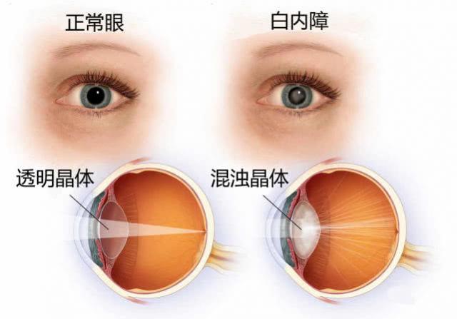中卫爱尔：白内障手术后需要注意什么(图1)