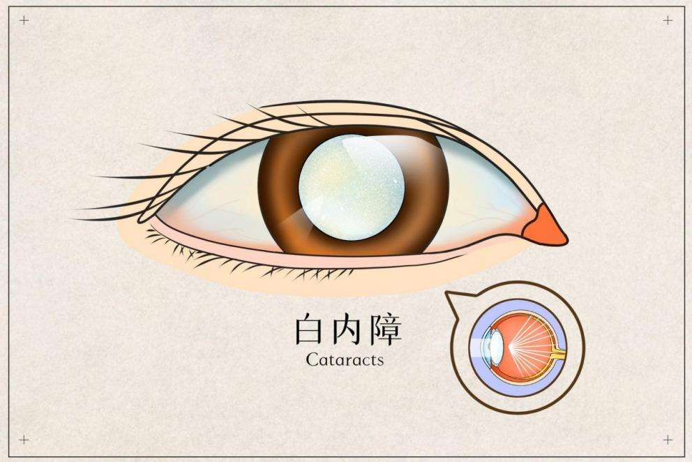 中卫眼科：白内障术后的注意事项有哪些(图1)