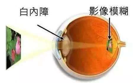 中卫眼科：做白内障手术会有危险吗(图1)