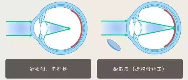 中卫眼科：角膜塑形镜控制青少年近视怎么样(图1)