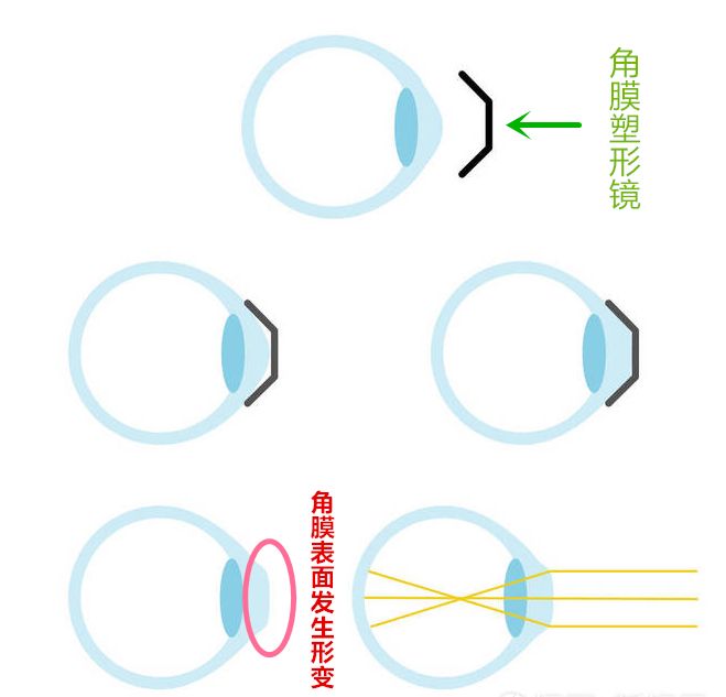 中卫眼科：角膜塑形镜有哪些优点(图1)