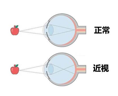 中卫爱尔：关于近视的传言你都了解多少？(图1)