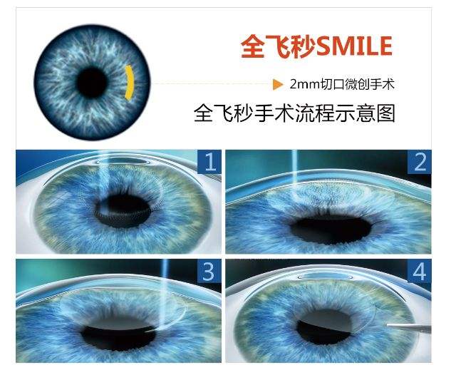 中卫眼科：做全飞秒手术疼吗(图1)